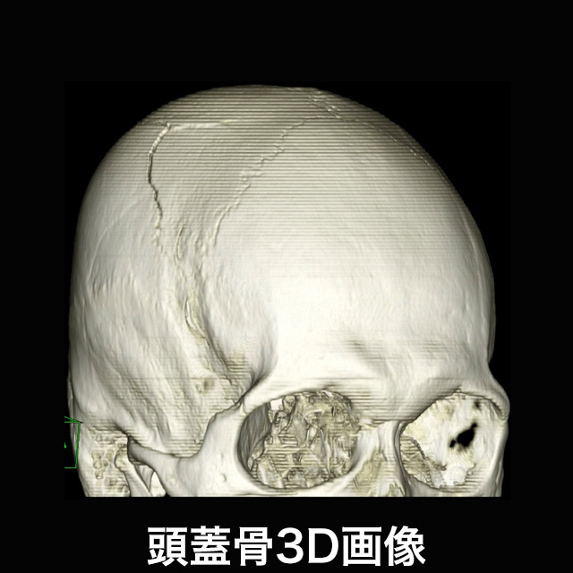 頭蓋骨3D画像